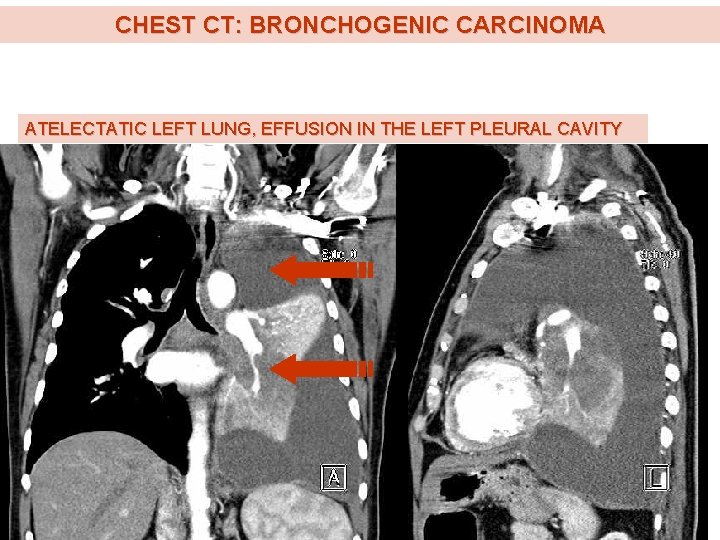 CHEST CT: BRONCHOGENIC CARCINOMA ATELECTATIC LEFT LUNG, EFFUSION IN THE LEFT PLEURAL CAVITY 