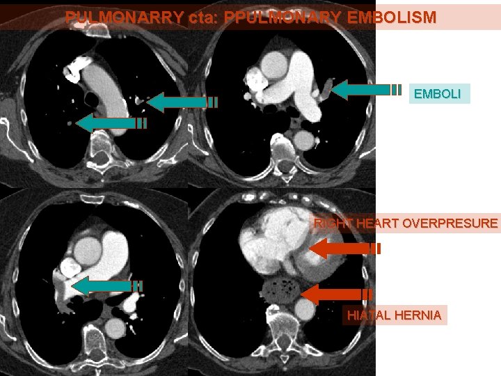 PULMONARRY cta: PPULMONARY EMBOLISM EMBOLI RIGHT HEART OVERPRESURE HIATAL HERNIA PULMONARRY cta: PPULMONARY EMBOLISM EMBOLI RIGHT HEART OVERPRESURE HIATAL HERNIA