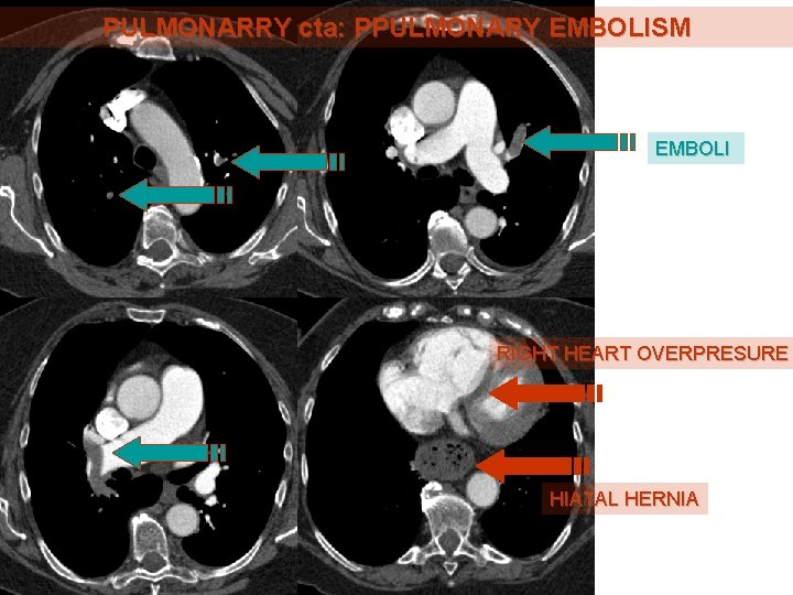 PULMONARRY cta: PPULMONARY EMBOLISM EMBOLI RIGHT HEART OVERPRESURE HIATAL HERNIA 