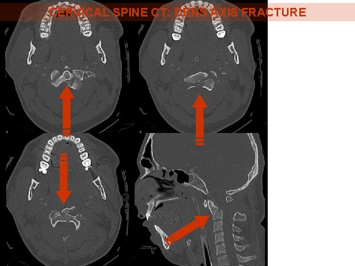 CERVICAL SPINE CT: DENS AXIS FRACTURE CERVICAL SPINE CT: DENS AXIS FRACTURE