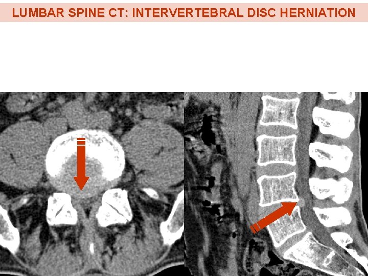 LUMBAR SPINE CT: INTERVERTEBRAL DISC HERNIATION LUMBAR SPINE CT: INTERVERTEBRAL DISC HERNIATION