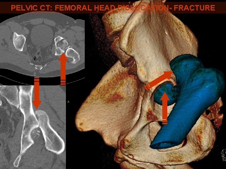 PELVIC CT: FEMORAL HEAD DISLOCATION- FRACTURE 