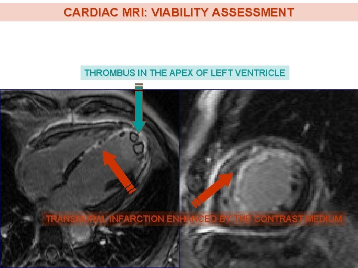 CARDIAC MRI: VIABILITY ASSESSMENT THROMBUS IN THE APEX OF LEFT VENTRICLE TRANSMURAL INFARCTION ENHANCED CARDIAC MRI: VIABILITY ASSESSMENT THROMBUS IN THE APEX OF LEFT VENTRICLE TRANSMURAL INFARCTION ENHANCED