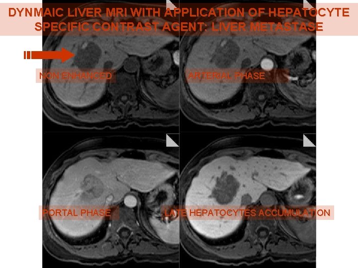 DYNMAIC LIVER MRI WITH APPLICATION OF HEPATOCYTE SPECIFIC CONTRAST AGENT: LIVER METASTASE NON ENHANCED DYNMAIC LIVER MRI WITH APPLICATION OF HEPATOCYTE SPECIFIC CONTRAST AGENT: LIVER METASTASE NON ENHANCED