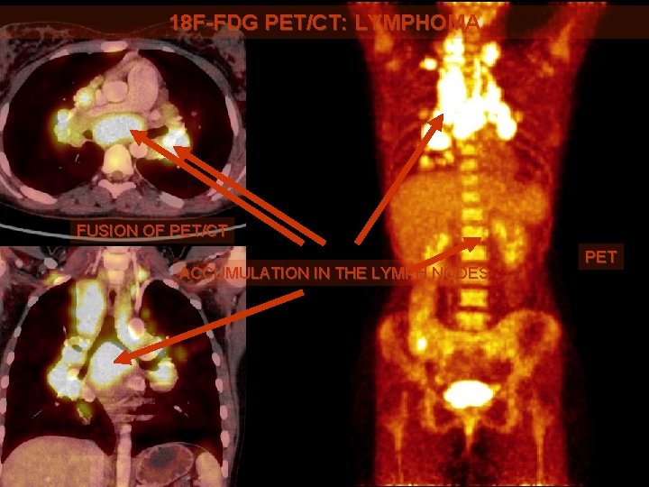 18 F-FDG PET/CT: LYMPHOMA FUSION OF PET/CT ACCUMULATION IN THE LYMPH NODES PET 