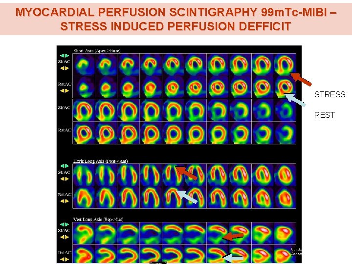 MYOCARDIAL PERFUSION SCINTIGRAPHY 99 m. Tc-MIBI – STRESS INDUCED PERFUSION DEFFICIT STRESS REST MYOCARDIAL PERFUSION SCINTIGRAPHY 99 m. Tc-MIBI – STRESS INDUCED PERFUSION DEFFICIT STRESS REST