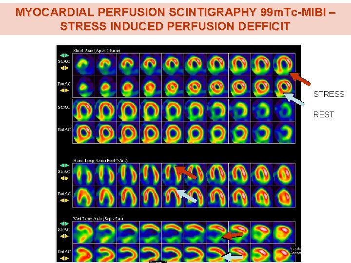 MYOCARDIAL PERFUSION SCINTIGRAPHY 99 m. Tc-MIBI – STRESS INDUCED PERFUSION DEFFICIT STRESS REST 