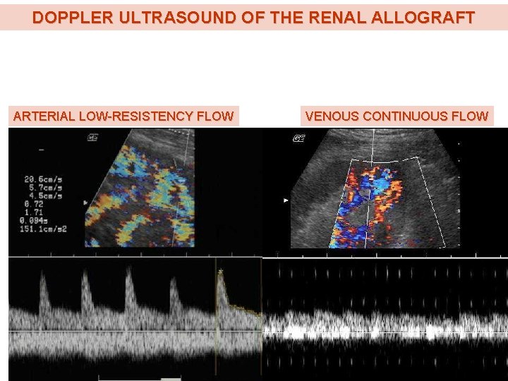 DOPPLER ULTRASOUND OF THE RENAL ALLOGRAFT ARTERIAL LOW-RESISTENCY FLOW VENOUS CONTINUOUS FLOW DOPPLER ULTRASOUND OF THE RENAL ALLOGRAFT ARTERIAL LOW-RESISTENCY FLOW VENOUS CONTINUOUS FLOW
