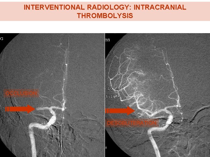 INTERVENTIONAL RADIOLOGY: INTRACRANIAL THROMBOLYSIS OCCLUSION DESOBLITERATION INTERVENTIONAL RADIOLOGY: INTRACRANIAL THROMBOLYSIS OCCLUSION DESOBLITERATION