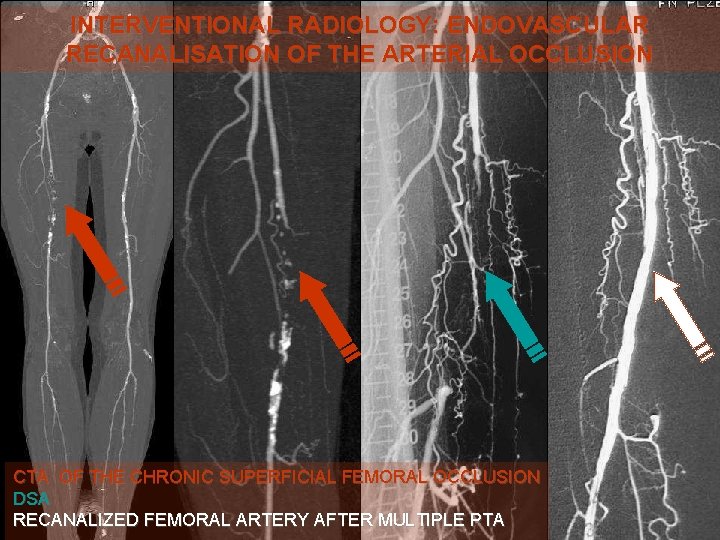 INTERVENTIONAL RADIOLOGY: ENDOVASCULAR RECANALISATION OF THE ARTERIAL OCCLUSION CTA OF THE CHRONIC SUPERFICIAL FEMORAL INTERVENTIONAL RADIOLOGY: ENDOVASCULAR RECANALISATION OF THE ARTERIAL OCCLUSION CTA OF THE CHRONIC SUPERFICIAL FEMORAL