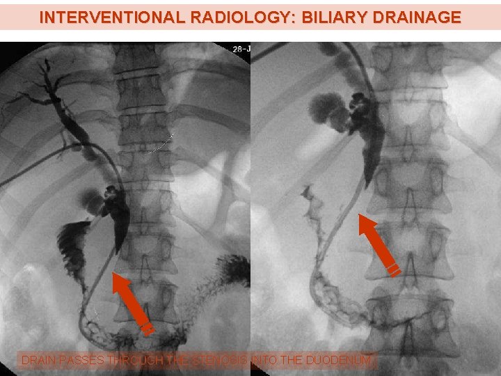 INTERVENTIONAL RADIOLOGY: BILIARY DRAINAGE DRAIN PASSES THROUGH THE STENOSIS INTO THE DUODENUM INTERVENTIONAL RADIOLOGY: BILIARY DRAINAGE DRAIN PASSES THROUGH THE STENOSIS INTO THE DUODENUM