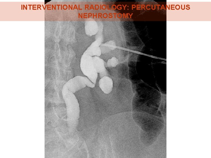INTERVENTIONAL RADIOLOGY: PERCUTANEOUS NEPHROSTOMY INTERVENTIONAL RADIOLOGY: PERCUTANEOUS NEPHROSTOMY
