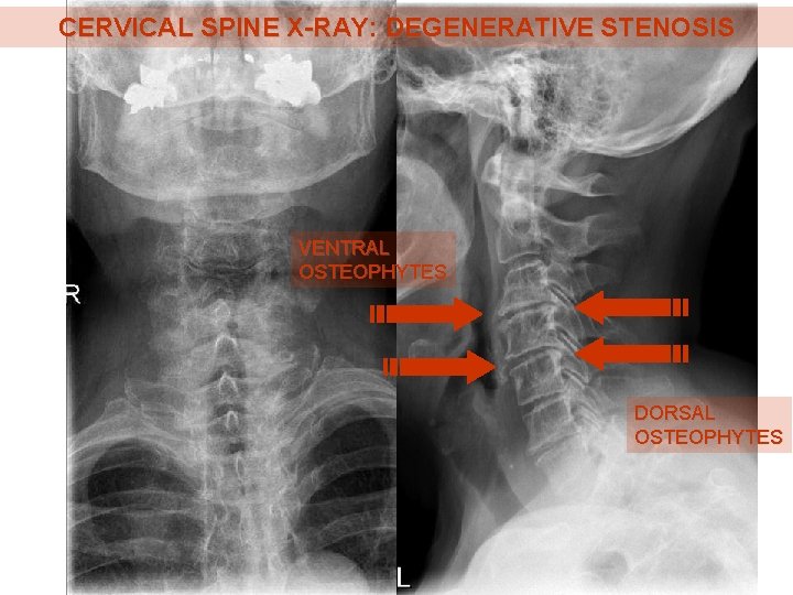 CERVICAL SPINE X-RAY: DEGENERATIVE STENOSIS VENTRAL OSTEOPHYTES DORSAL OSTEOPHYTES 