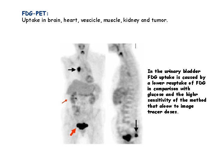 FDG-PET: Uptake in brain, heart, vescicle, muscle, kidney and tumor. In the urinary bladder