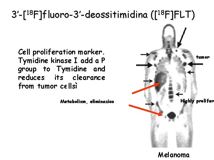 3’-[18 F]fluoro-3’-deossitimidina ([18 F]FLT) Cell proliferation marker. Tymidine kinase I add a P group