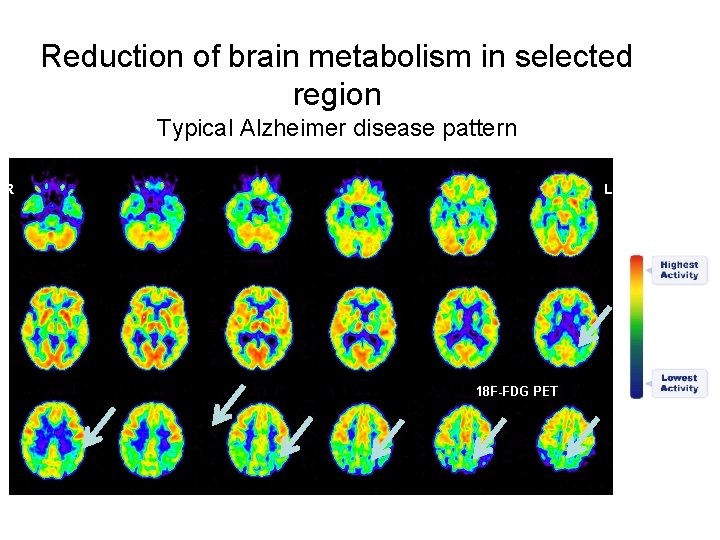 Reduction of brain metabolism in selected region Typical Alzheimer disease pattern R L 