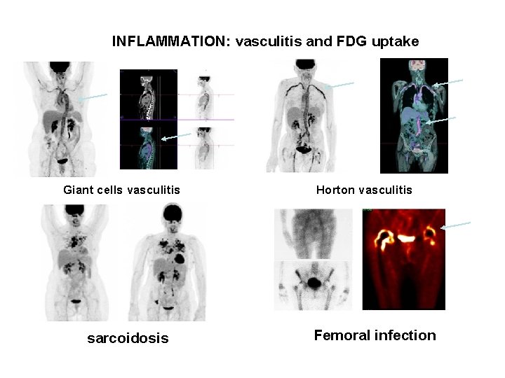 INFLAMMATION: vasculitis and FDG uptake Giant cells vasculitis Horton vasculitis sarcoidosis Femoral infection 