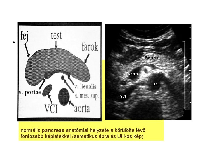  • normális pancreas anatómiai helyzete a körülötte lévõ fontosabb képletekkel (sematikus ábra és