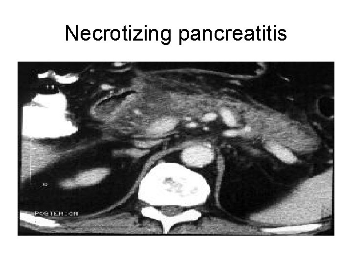 Necrotizing pancreatitis 