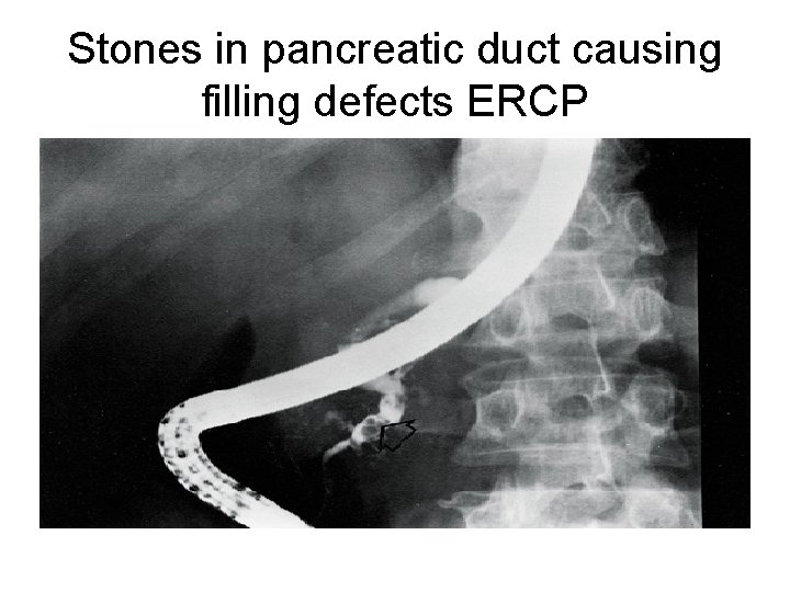 Stones in pancreatic duct causing filling defects ERCP 