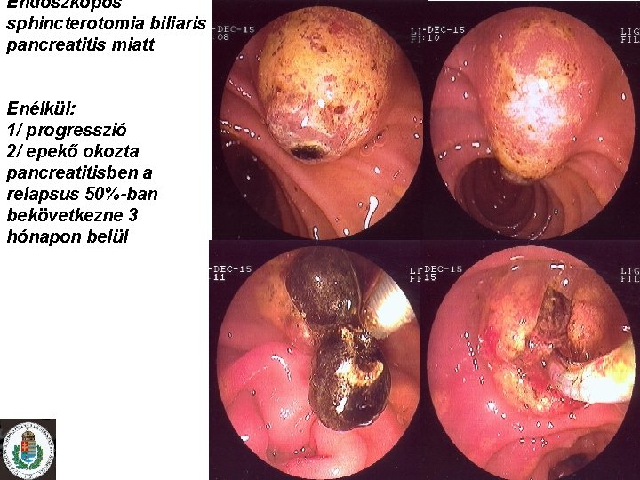Endoszkópos sphincterotomia biliaris pancreatitis miatt Enélkül: 1/ progresszió 2/ epekő okozta pancreatitisben a relapsus
