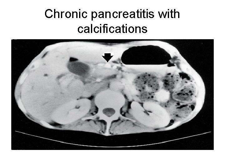 Chronic pancreatitis with calcifications 