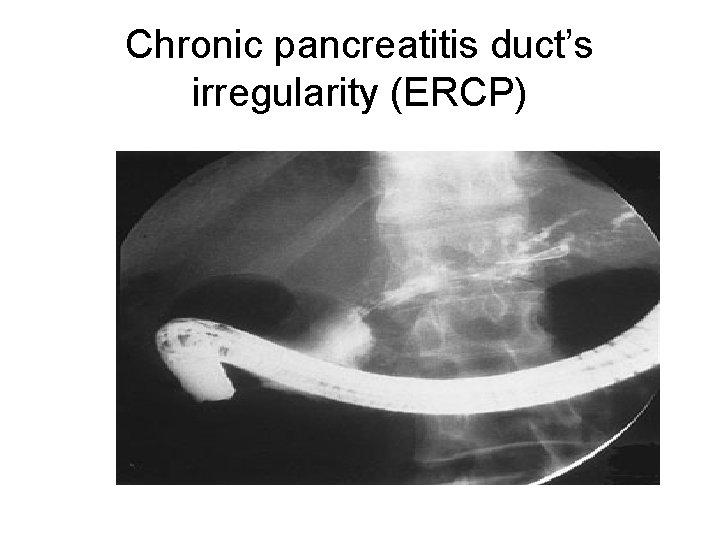 Chronic pancreatitis duct’s irregularity (ERCP) 