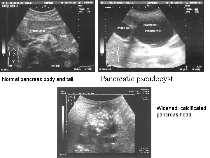 Normal pancreas body and tail Pancreatic pseudocyst Widened, calcificated pancreas head 
