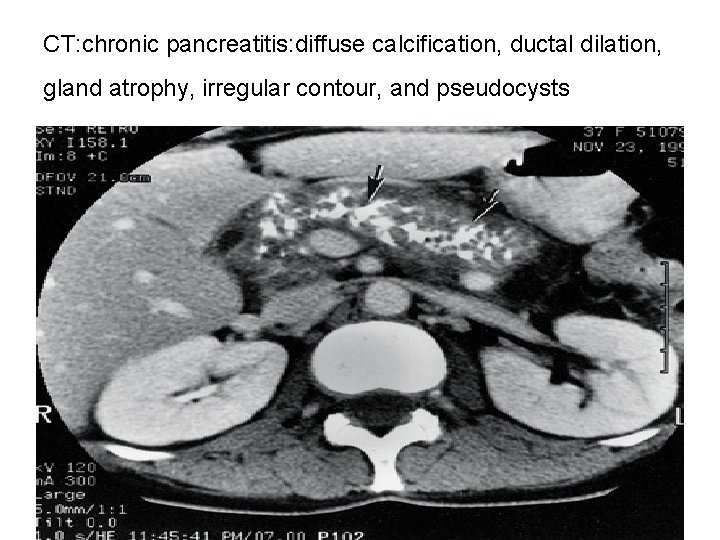 CT: chronic pancreatitis: diffuse calcification, ductal dilation, gland atrophy, irregular contour, and pseudocysts 
