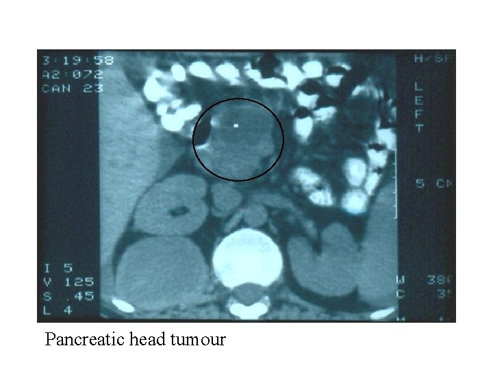 Pancreatic head tumour 