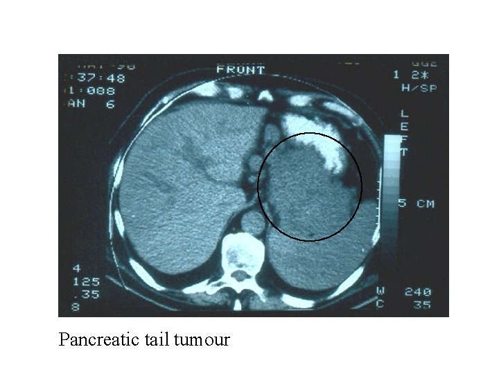 Pancreatic tail tumour 