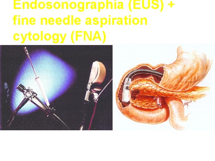 Endosonographia (EUS) + fine needle aspiration cytology (FNA) 