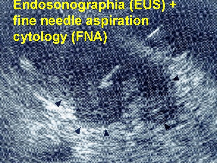 Endosonographia (EUS) + fine needle aspiration cytology (FNA) 