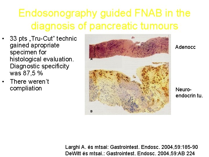 Endosonography guided FNAB in the diagnosis of pancreatic tumours • 33 pts „Tru-Cut” technic
