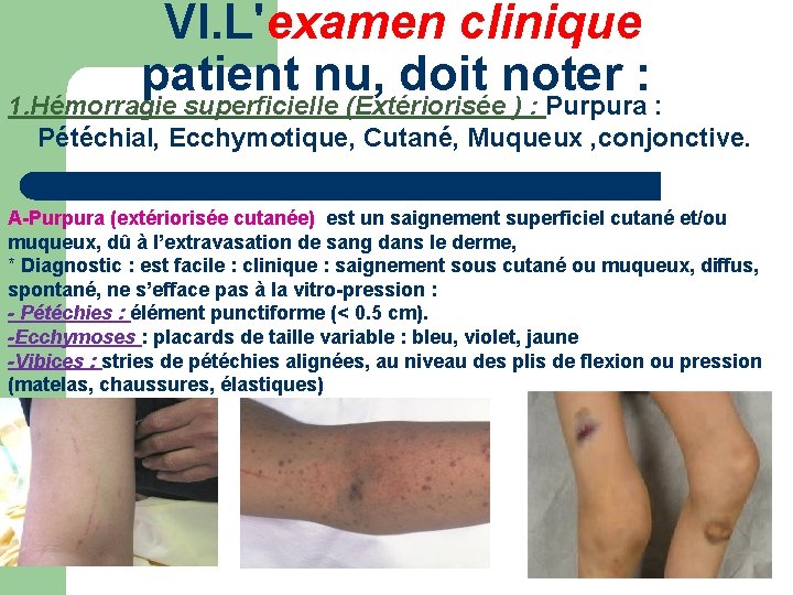 VI. L'examen clinique patient nu, doit noter : 1. Hémorragie superficielle (Extériorisée ) :