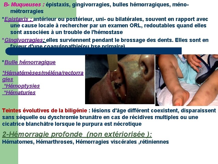 B- Muqueuses : épistaxis, gingivorragies, bulles hémorragiques, ménométrorragies *Epistaxis : antérieur ou postérieur, uni-