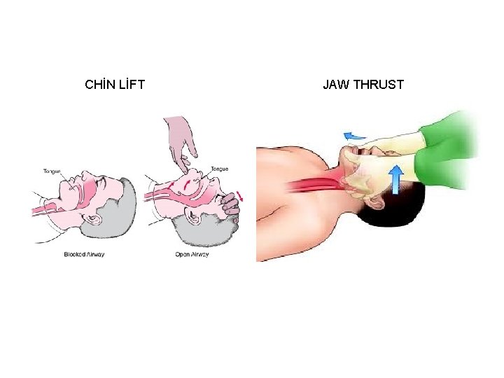 CHİN LİFT JAW THRUST 