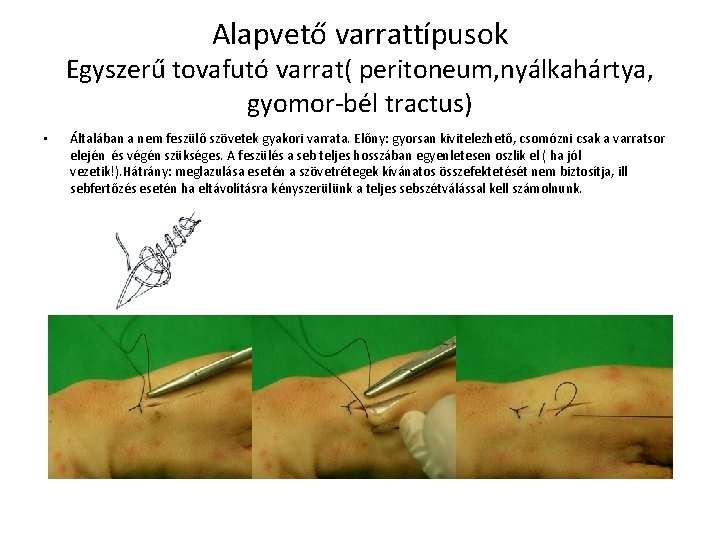 Alapvető varrattípusok Egyszerű tovafutó varrat( peritoneum, nyálkahártya, gyomor-bél tractus) • Általában a nem feszülő