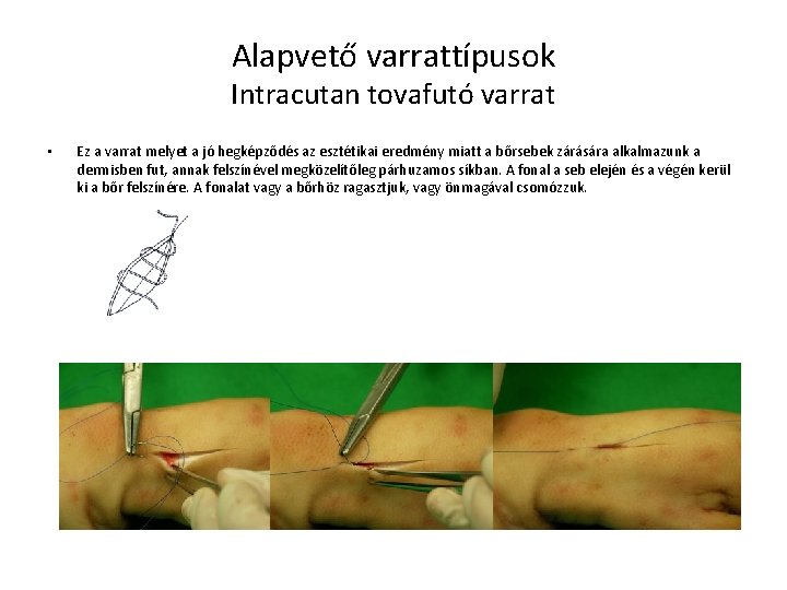 Alapvető varrattípusok Intracutan tovafutó varrat • Ez a varrat melyet a jó hegképződés az