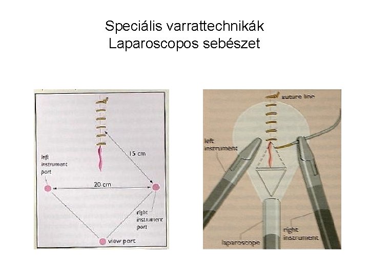Speciális varrattechnikák Laparoscopos sebészet 