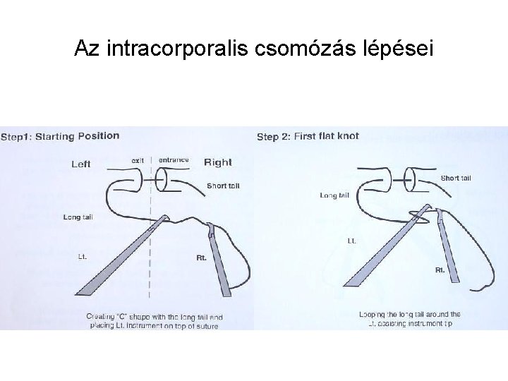 Az intracorporalis csomózás lépései 