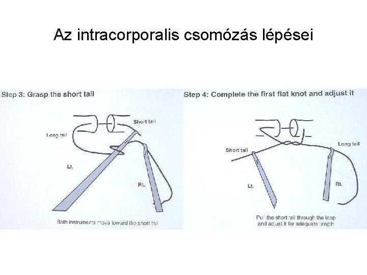 Az intracorporalis csomózás lépései 