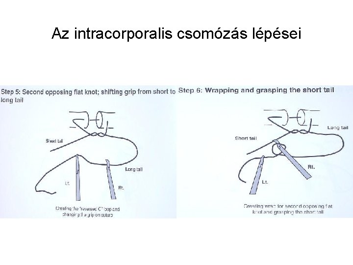 Az intracorporalis csomózás lépései 