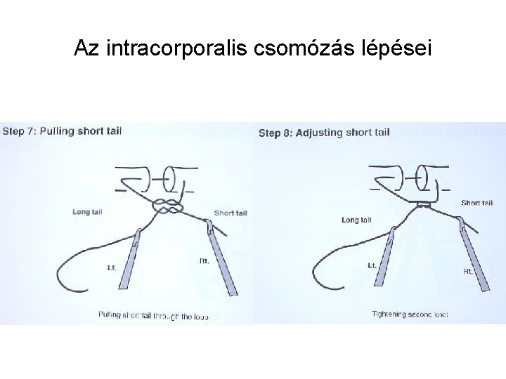 Az intracorporalis csomózás lépései 