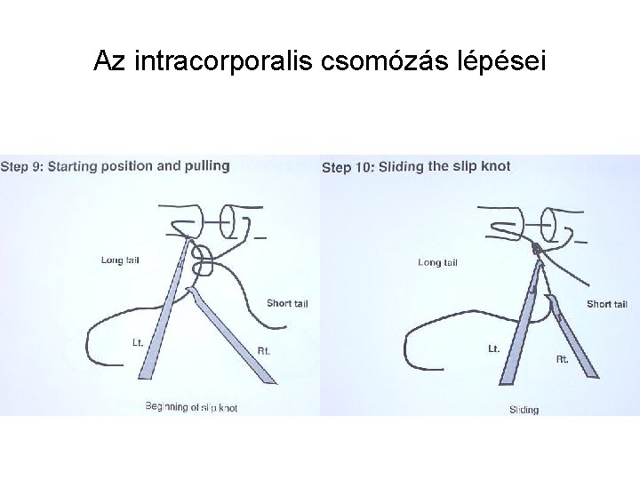 Az intracorporalis csomózás lépései 