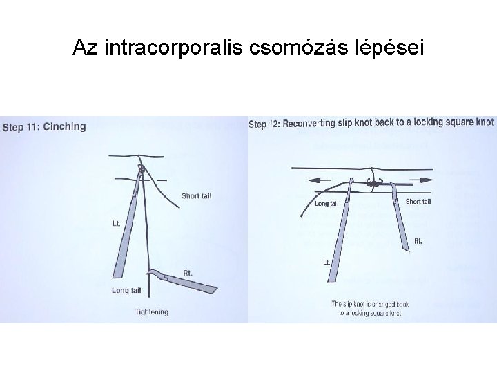 Az intracorporalis csomózás lépései 