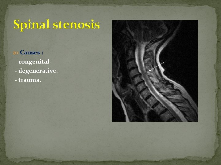 Spinal stenosis Causes : - congenital. - degenerative. - trauma. 