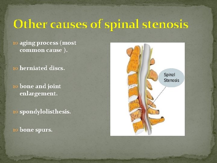 Other causes of spinal stenosis aging process (most common cause ). herniated discs. bone