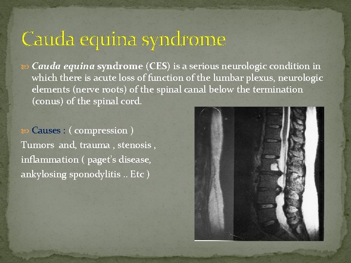 Cauda equina syndrome (CES) is a serious neurologic condition in which there is acute