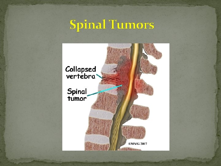  Spinal Tumors 